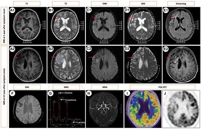 Case report: A case of primary angiitis of the central nervous system: misdiagnosed for 3.5 years